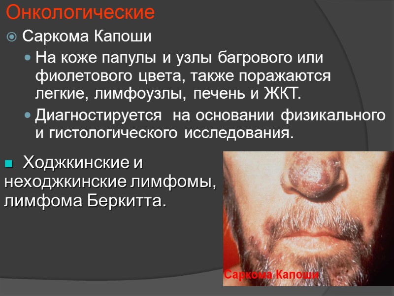 Онкологические Саркома Капоши На коже папулы и узлы багрового или фиолетового цвета, также поражаются